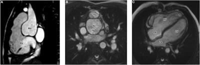 Aorto-Right Ventricular Tunnel in Transposition of the Great Arteries